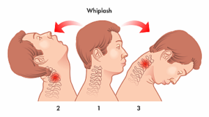 Stages of a Whiplash Injury